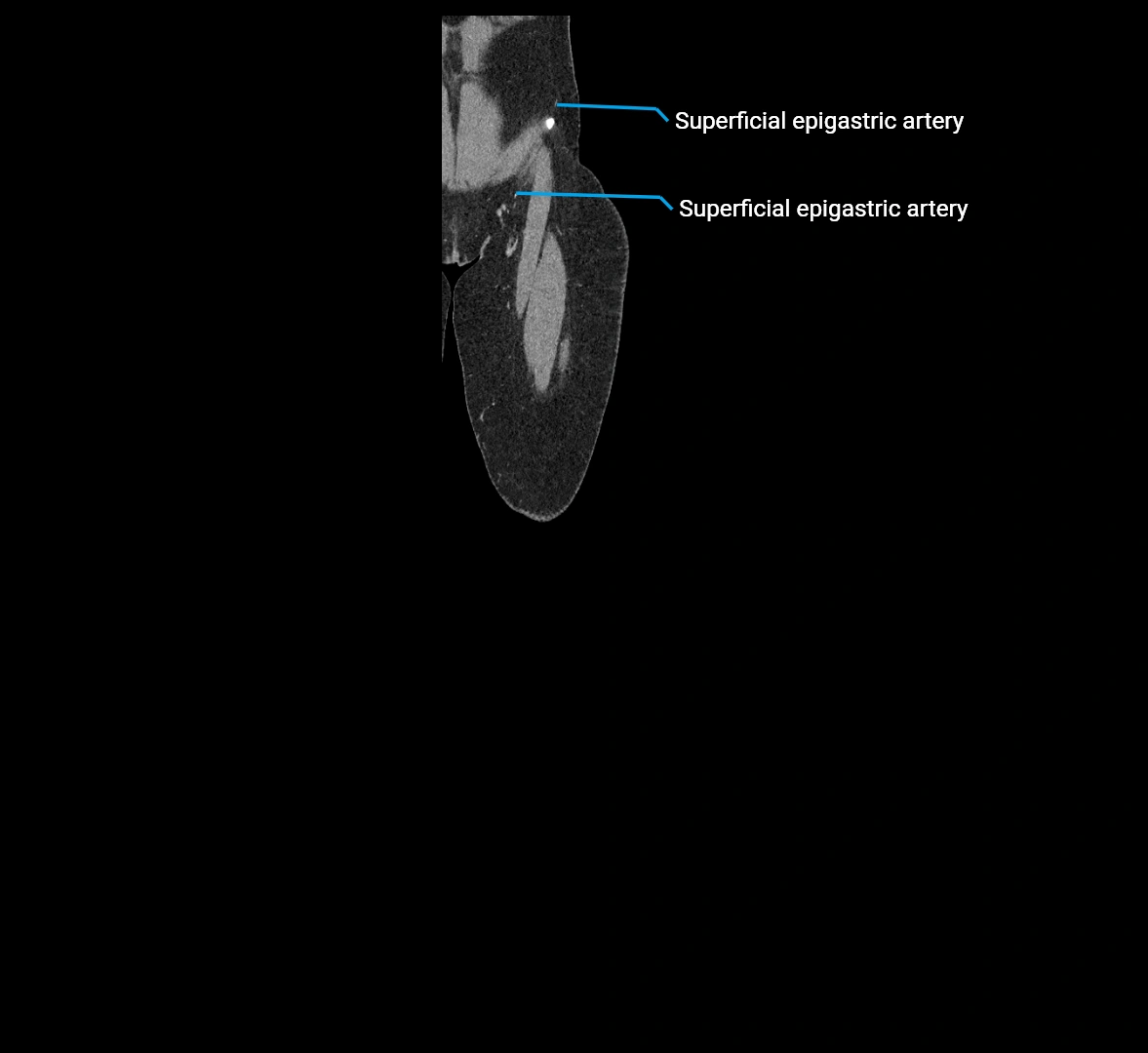 CTA lower limb coronal cross sectional anatomy labelled image _5 (1).webp